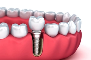 Overdenture Financing - Dental Care with Smile Center