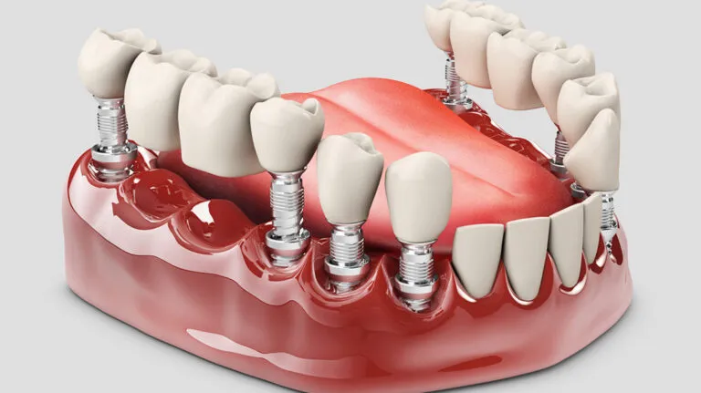 Full Arch - Dental Services with Smile Center